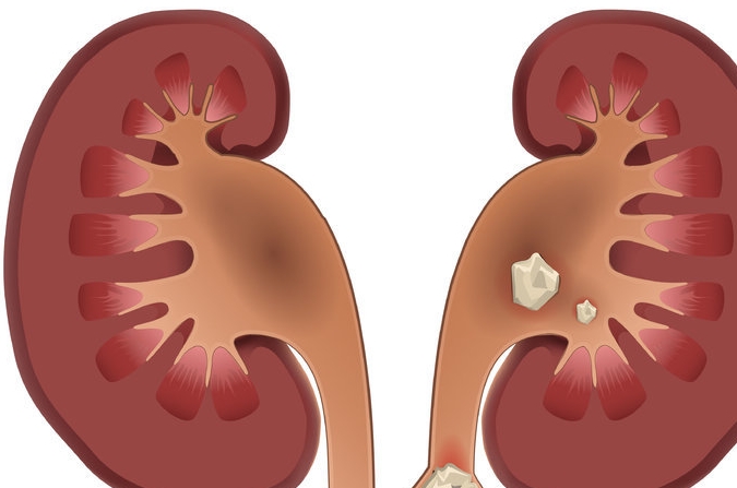 尿酸|患上肾结石怎么办？医生：牢记3个禁忌，有效避免结石长大