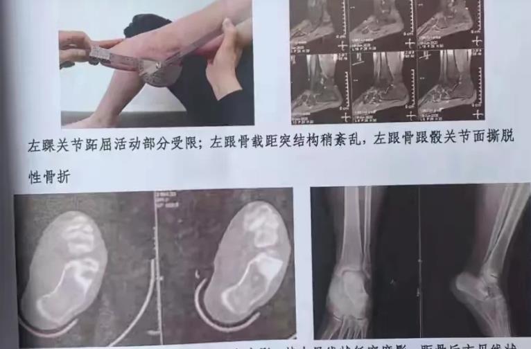 要求|四川学生宿舍被搜出零食，被学姐要求做150个深蹲，现已终身残疾