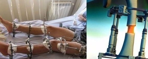 严重想增高，先断腿！断骨增高到底有多可怕？
