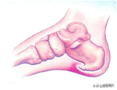 如何快速治疗足跟痛 bd30d2f7da8246f2a2fb3106808893d5.png