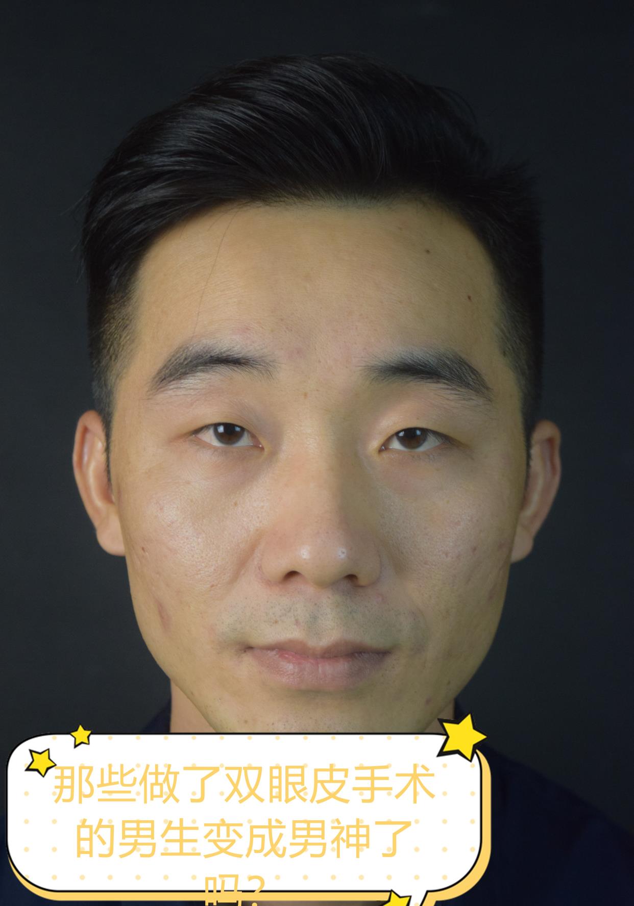单眼皮那些做了双眼皮手术的男生变成男神了吗？