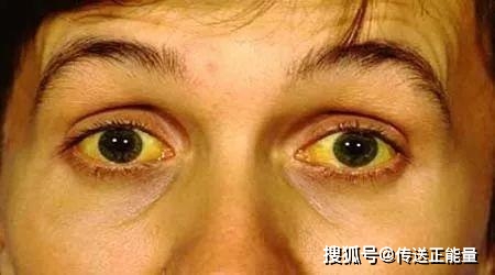 血液|肝内有癌，皮肤知晓！皮肤有这四“异常”，建议及时治疗