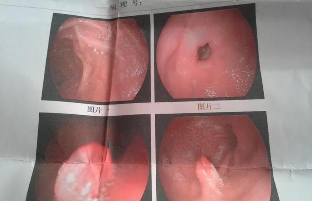 医生 这种胃息肉一定要切除