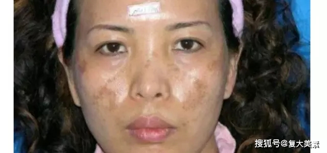 眼睛复大美素：要祛斑，这些色斑面诊原理你要懂！