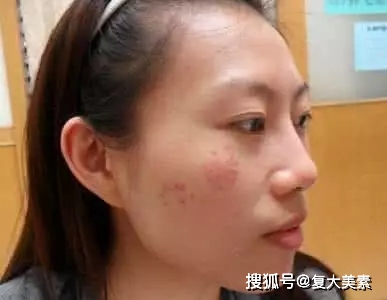 眼睛复大美素：要祛斑，这些色斑面诊原理你要懂！