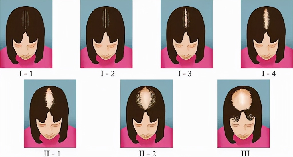 代谢|要是早知道这几招，最起码少掉几万根头发，心痛…