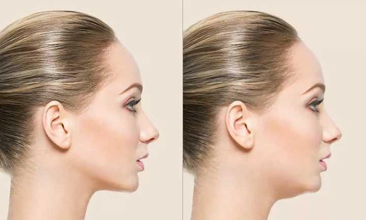 对称性「郭昌灏院长」面部脂肪填充3大黄金美学标准，你一定要知道