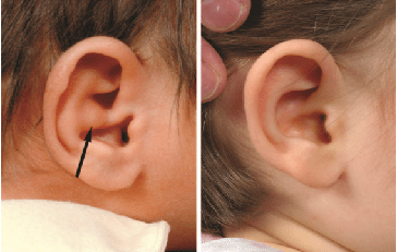 新生儿先天性耳廓畸形矫正早发现早治疗