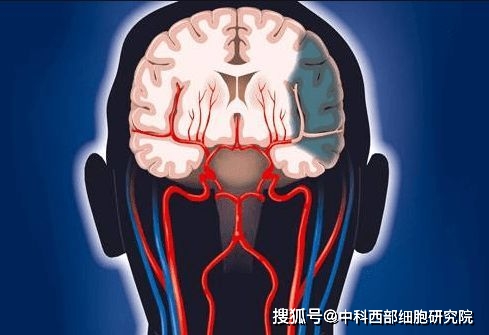 脑梗塞是什么系统 d5cf41a93b164745b9dd0b5b4cca04de.jpeg