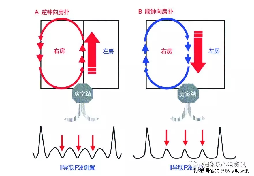 图11 逆钟向和顺钟向两种房扑f 波的特征晚近,2015 年美国aha,acc,hrs