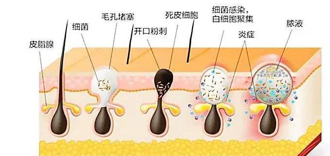 因为最好的祛痘方法，或许不是戒掉辣椒，而是这样东西