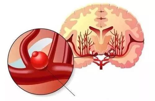 癥狀|顱內動脈瘤介入術后要注意什么？