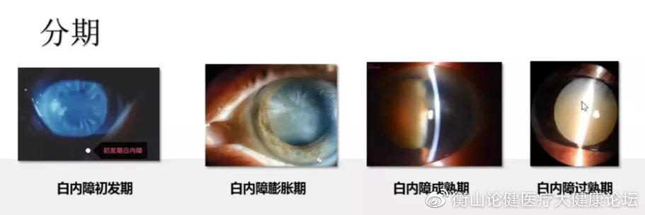 白内障分期:白内障病因:年龄,先天,外伤,并发白内障是一种无痛性的