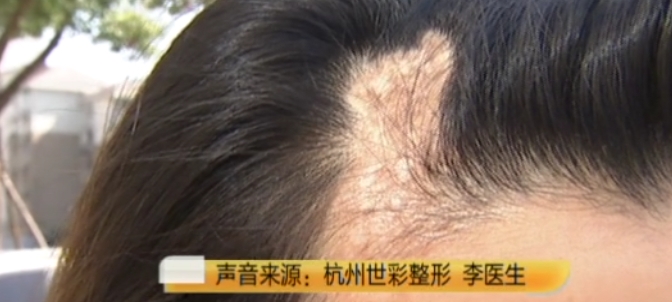 整形女子花4万做整形头顶变秃？怒找媒体曝光，网友列7项“标准”回复