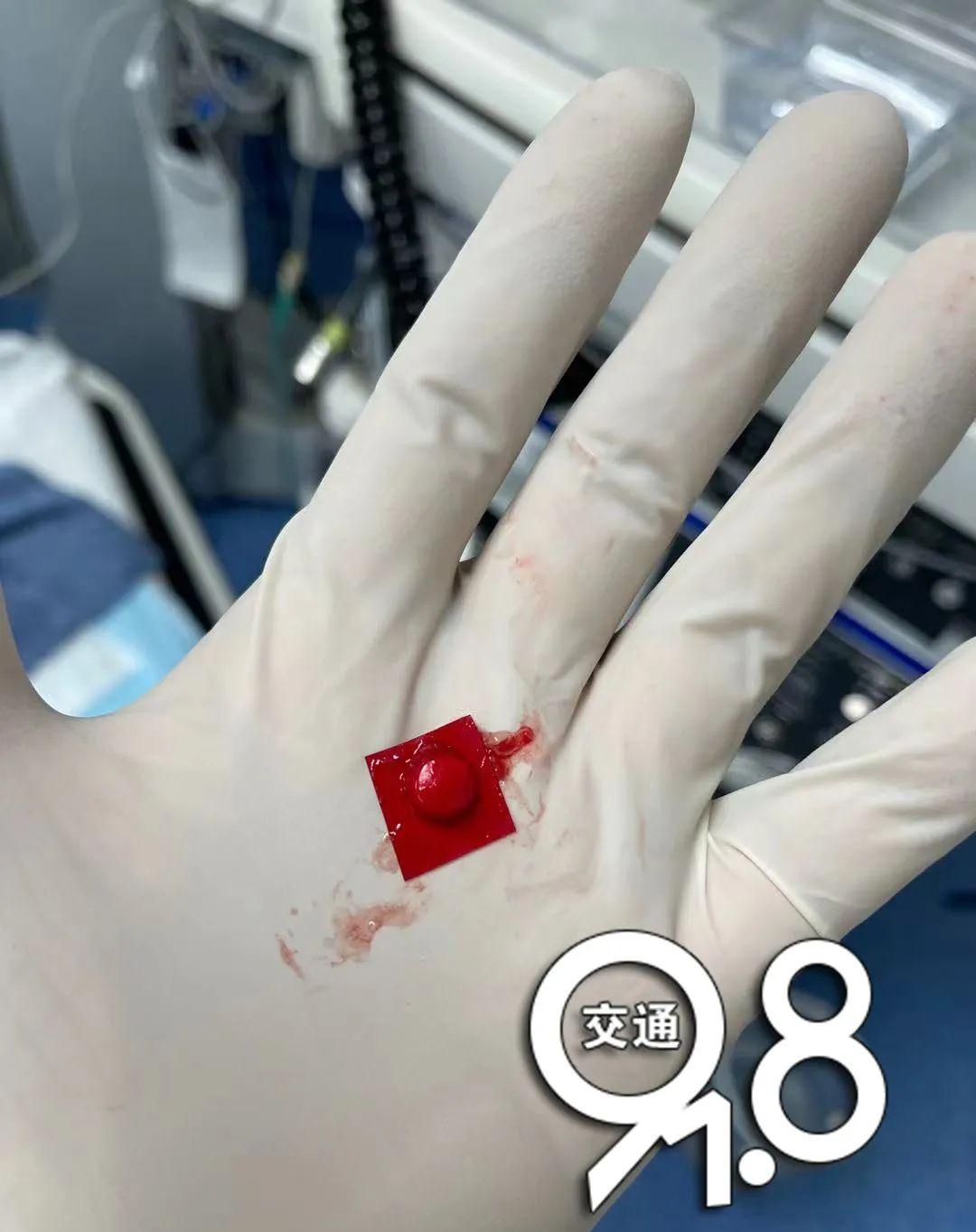 带着|九旬阿婆吃药被卡，竟从胃里掏出了带着完整铝箔外包装的药片