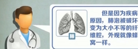 活动|肺纤维化是怎么回事?咳嗽、气短,这三类人是高危人群