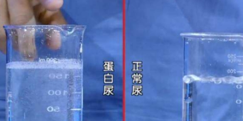 肾脏|糖尿病前期有征兆，当身体有这些症状时，小心糖尿病侵袭！