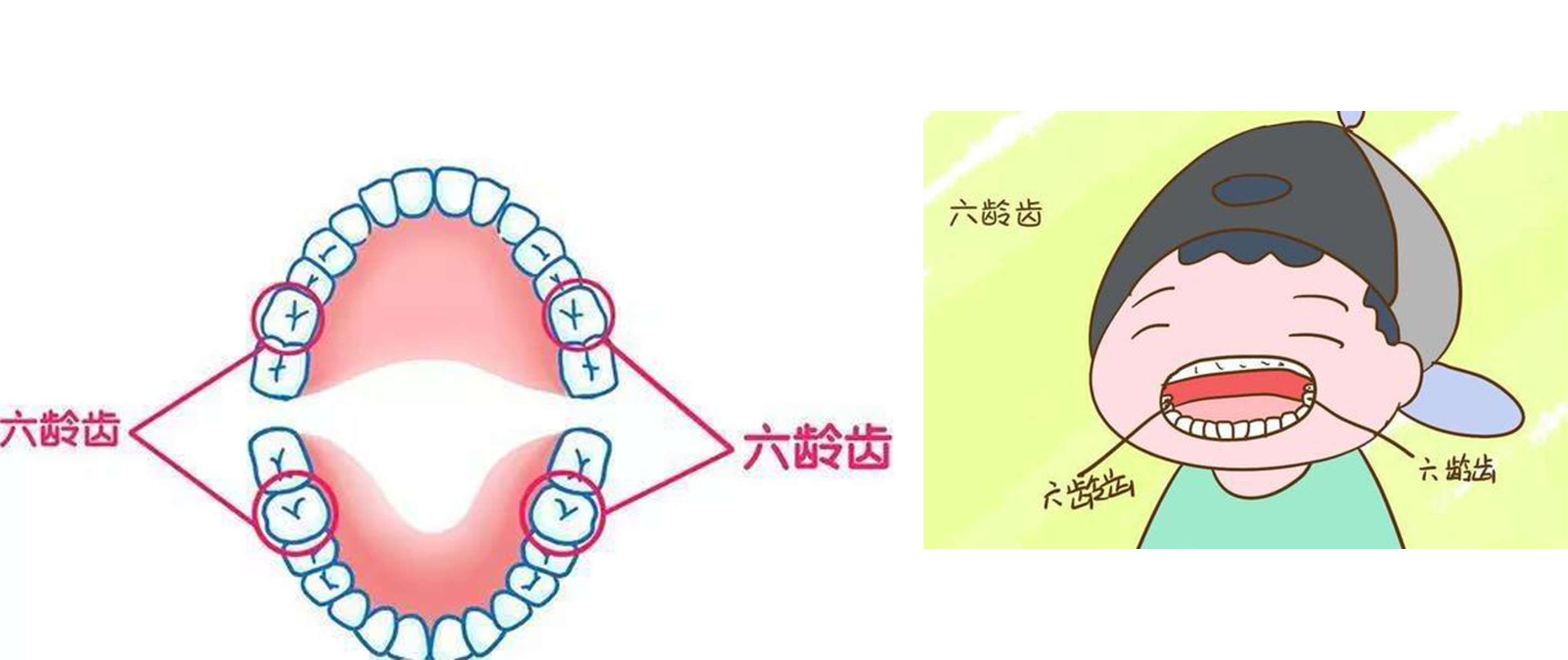 六龄牙是孩子六岁时长出的上下左右各一颗的大牙,也叫第一恒磨牙.