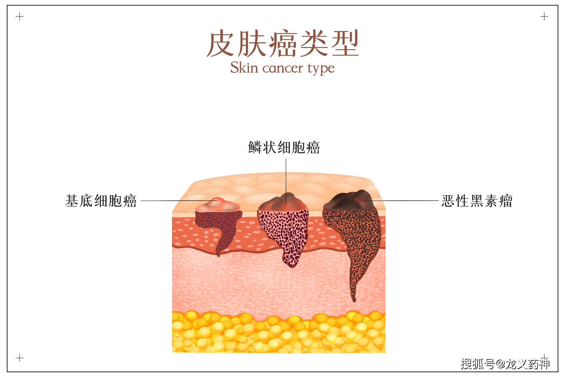 皮肤癌是皮肤上出现的一些显著的变化,不同的类型在症状上也不一样