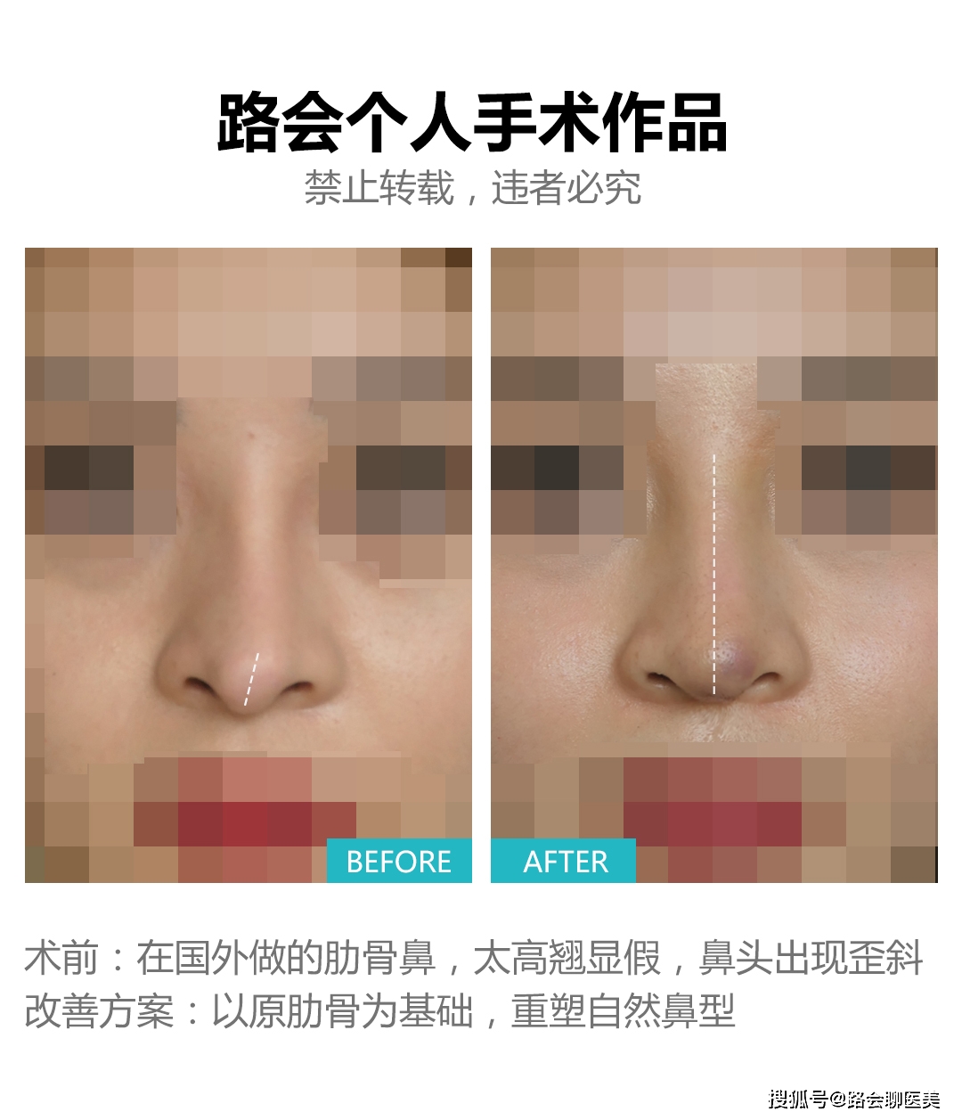 整形医生，你太搞笑了吧？做“妈生鼻子”不就是在做“寂寞”吗？