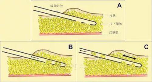 上臂吸脂修复任学会专业解答手臂吸脂后凹凸不平如何修复