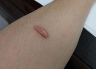 疤痕凸起增生了该怎么办怎么阻止疤痕越长越大