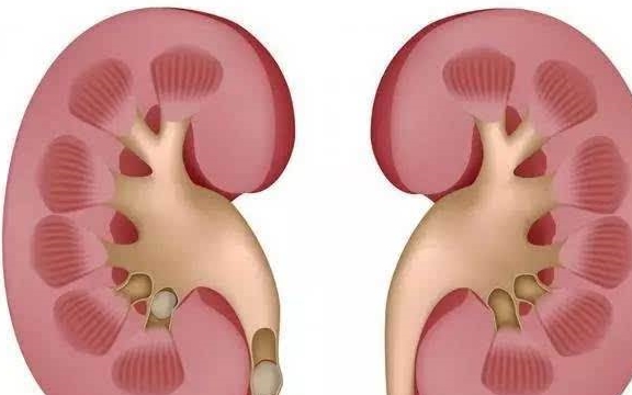 肾脏|肾结石有哪些危害，如何预防？