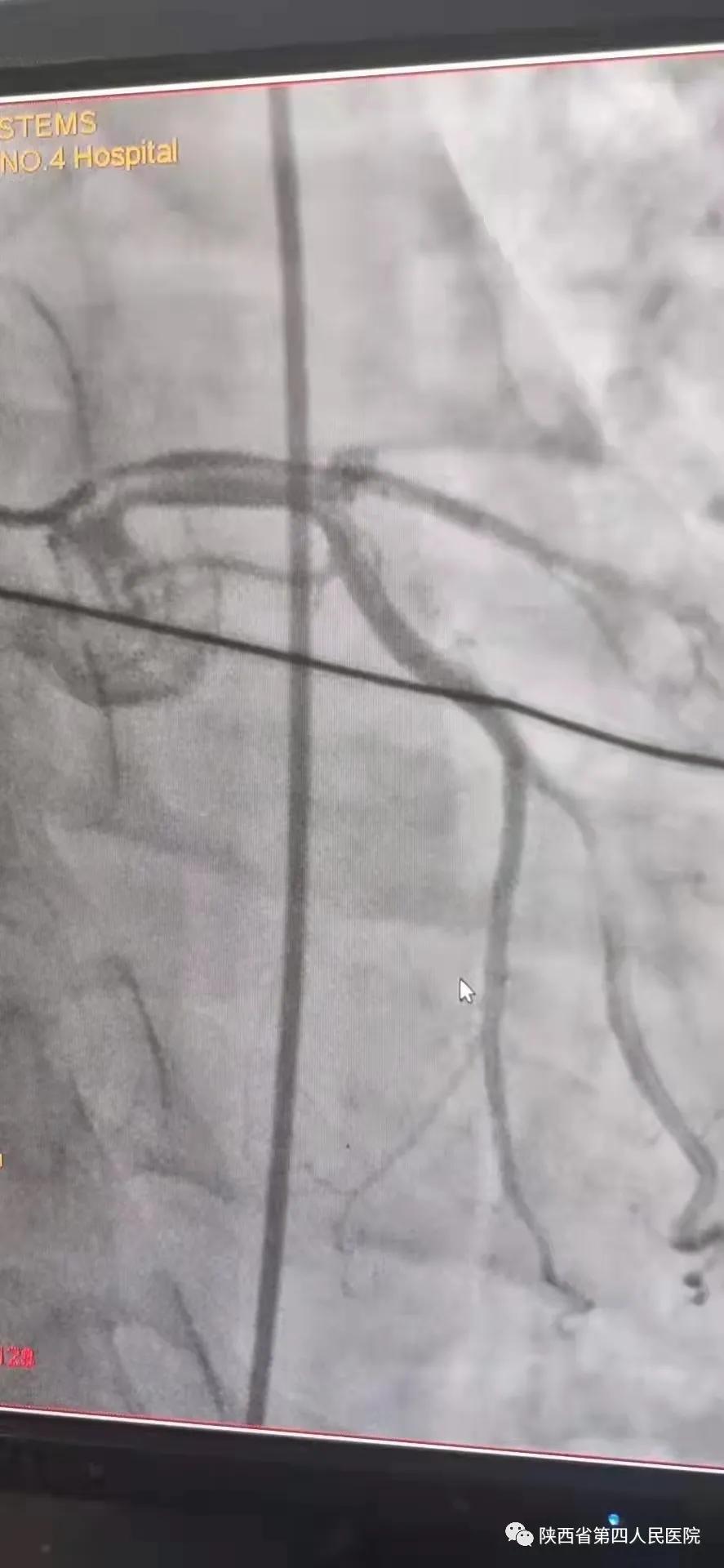 成功|心梗救治，分秒必争--陕西省第四人民医院心内科成功抢救一名急性心肌梗死患者
