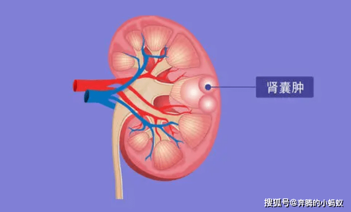 肾脏|得了肾囊肿很慌?这些生活细节要留心!