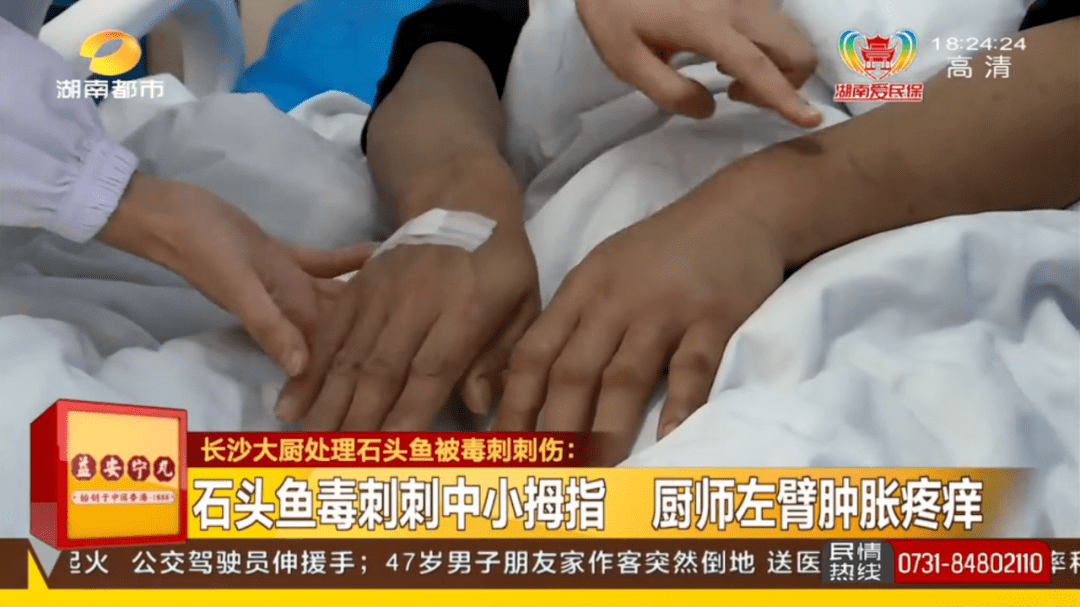 長沙|男子被魚刺扎一下緊急送醫！醫生：?這種魚刺毒性極強！6根可致死