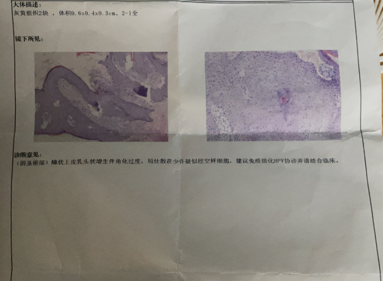 50岁村妇查出hpv感染伴宫颈病变医生3个现象要多关注