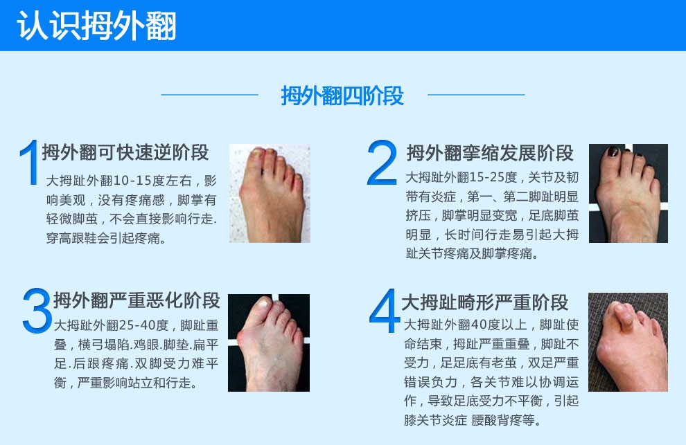 关节|上海健桥医院侯明主任：拇外翻最佳手术年龄