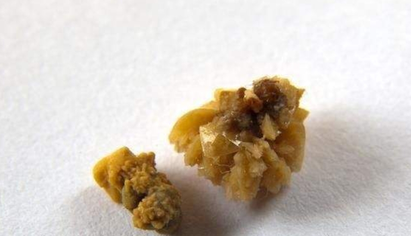 肾脏|肾结石为什么白天不痛，而晚上痛的非常厉害呢？