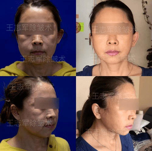 消息资讯|西安国际医学整形医院王志军教授 警惕！整形美容变毁容