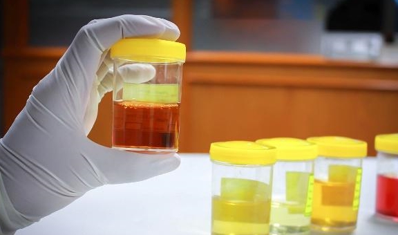 严重|为什么有的肾病发展到尿毒症才发现?可能忽视这个细节,不妨看看