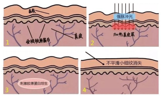 艾美莉盐城艾美莉整形医生告诉你：选择水光针还是光子嫩肤