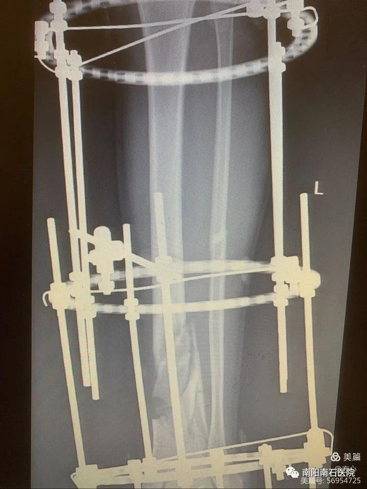 南石醫院粉碎性骨折患者伊裡扎洛夫不切口外固定術後3天下床獲患者