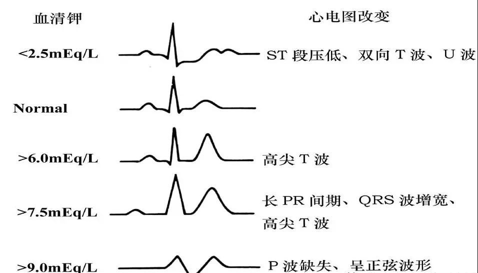 严重|高血钾症怎么治疗，带你全面了解