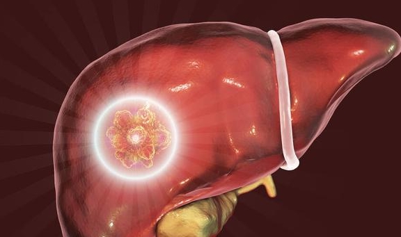 肝脏|肝硬化就和肝癌一样可怕？这4个原因，可能会让肝硬得像石头