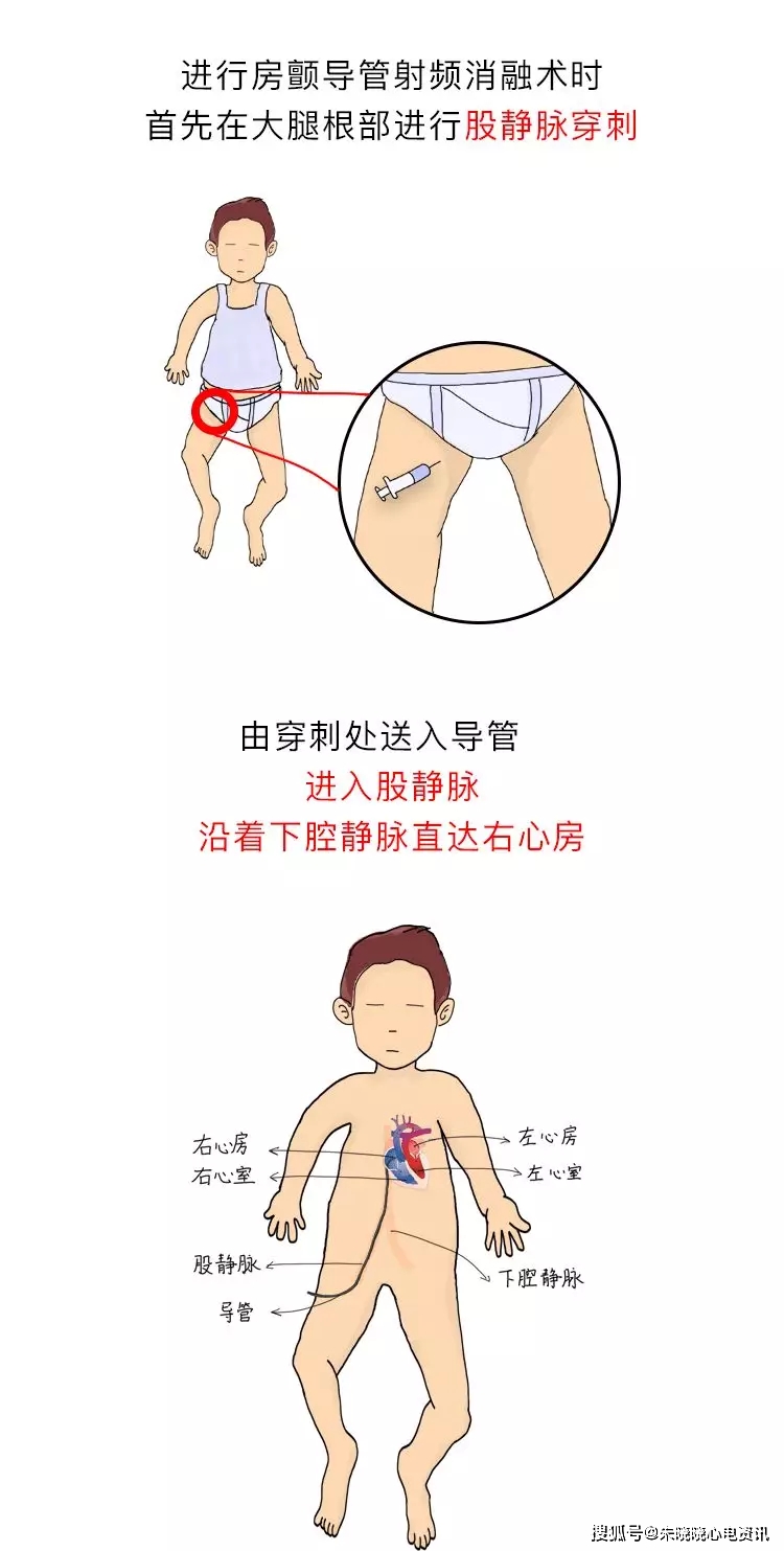 房颤|你了解房颤吗?一文图解掌握