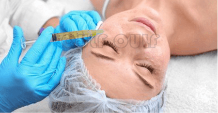 脸部全面还原:脸部脂肪填充恢复过程，全脸脂肪填充5到10天照片~