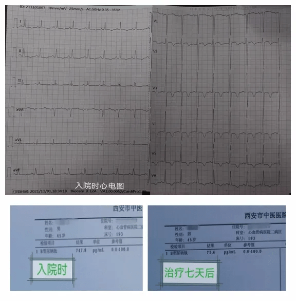 诊断:扩张型心肌病,心力衰竭-心功能2-3级(nyha)