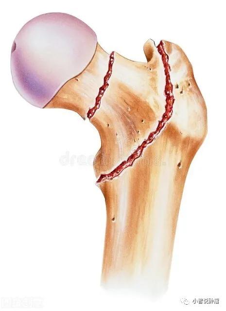 预防骨质疏松,任何年龄段的人都需要补钙_骨骼_骨质疏松症_摄入量