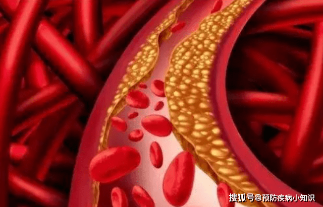 怎么知道自己的血管堵塞 d038ad2e588e4f85ac15f638e7b9c627.png