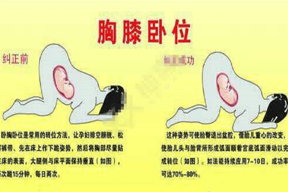 如果是枕前位还符合顺产条