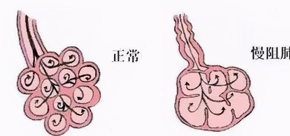 心功能|这种疾病须吃“高脂饮食”!近年来高发,要警惕
