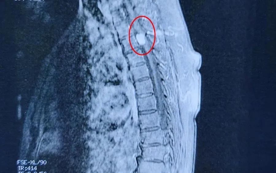 胸椎椎管内肿瘤"搞鬼"六旬老人千里求医终获新生