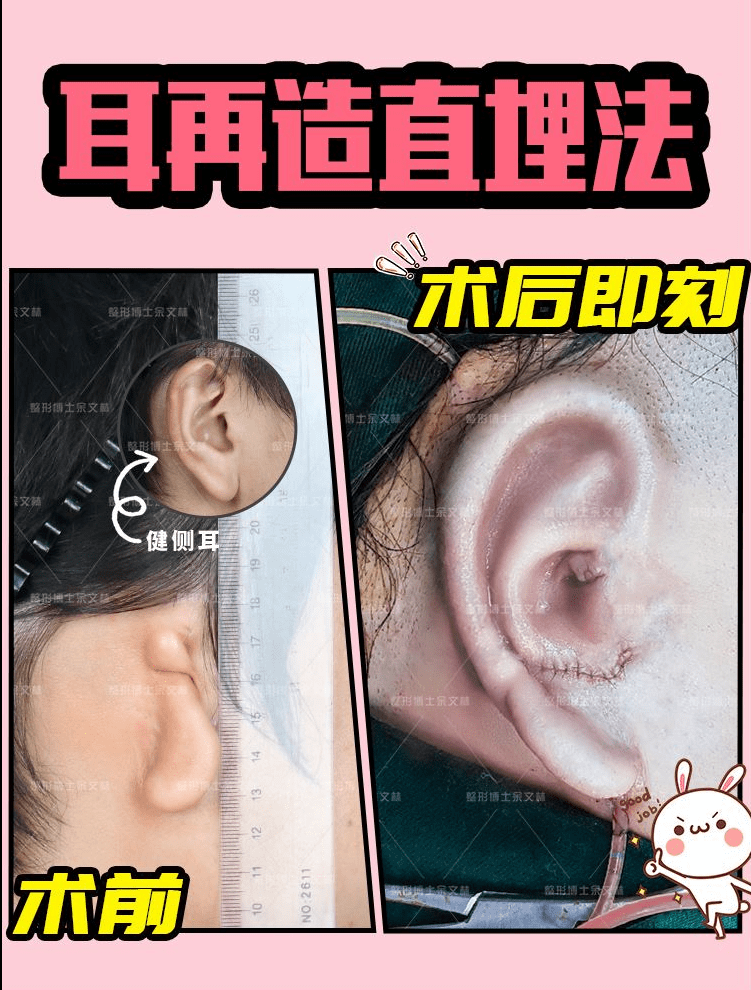 67耳再造二期手术效果图小耳畸形再造术多久才能恢复好
