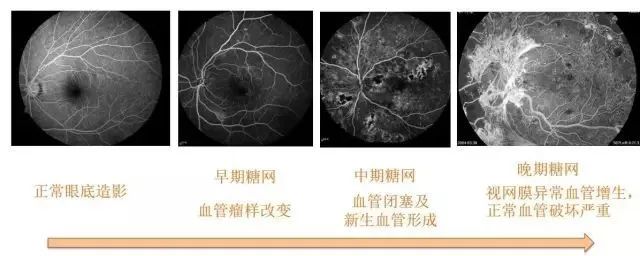 并发症|瑞乾坤健告诉您—当视网膜血管长期“高糖”，致盲并非危言耸听