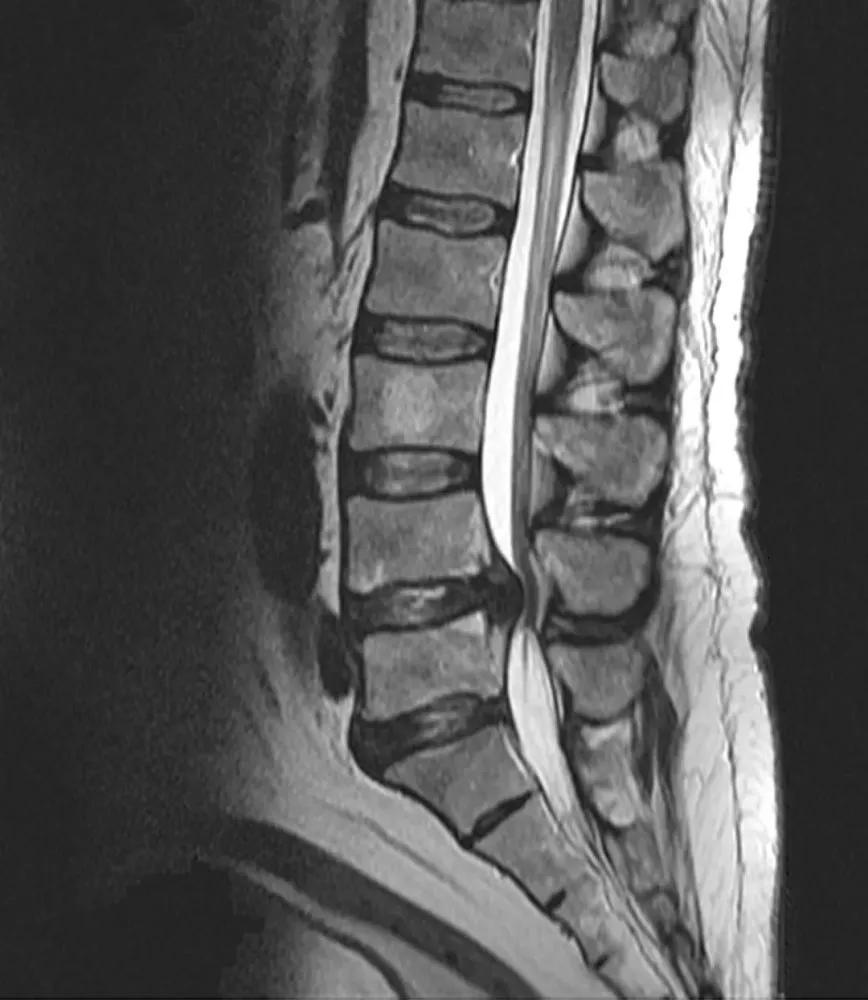 关节|影像检查｜DR&amp; CT&amp; MRI，在椎间盘疾病中如何选择呢？